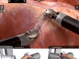 „Intuitive Surgical“ nuotr./Robotu „Da Vinci“ atliekama operacija