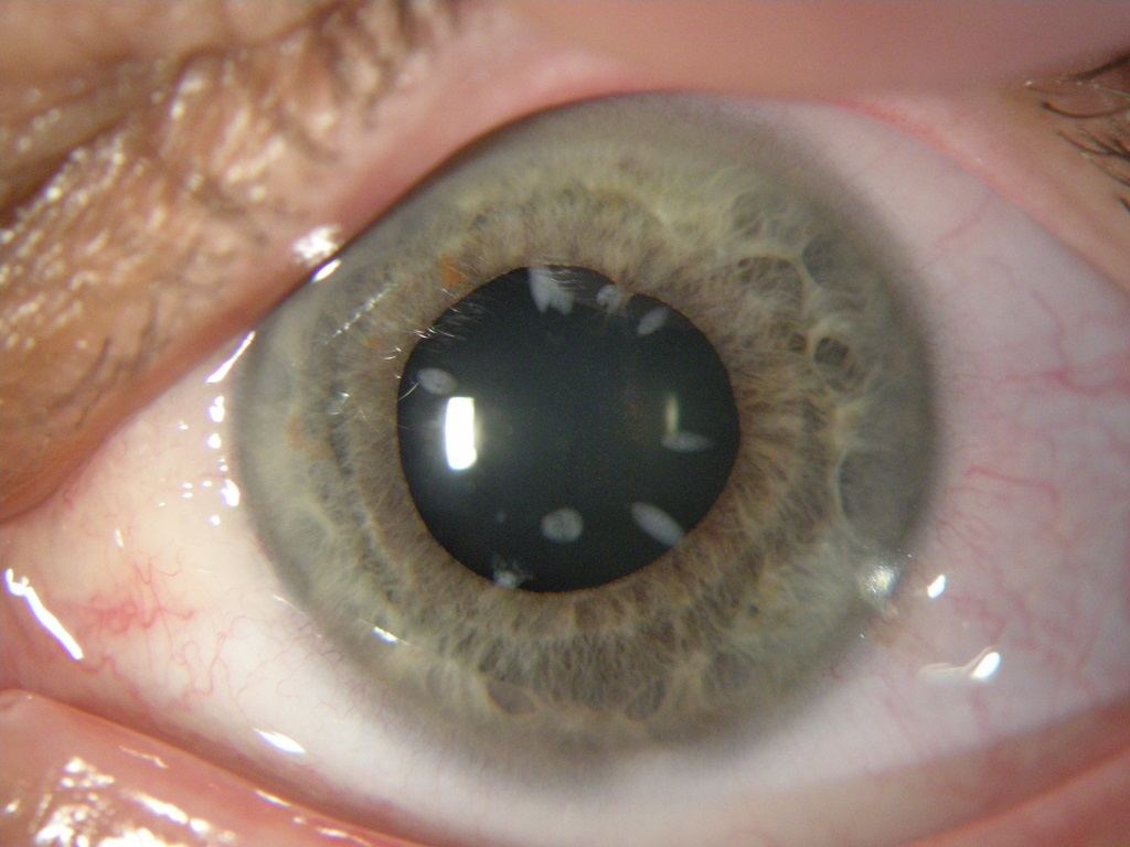 akių liga su hipertenzija