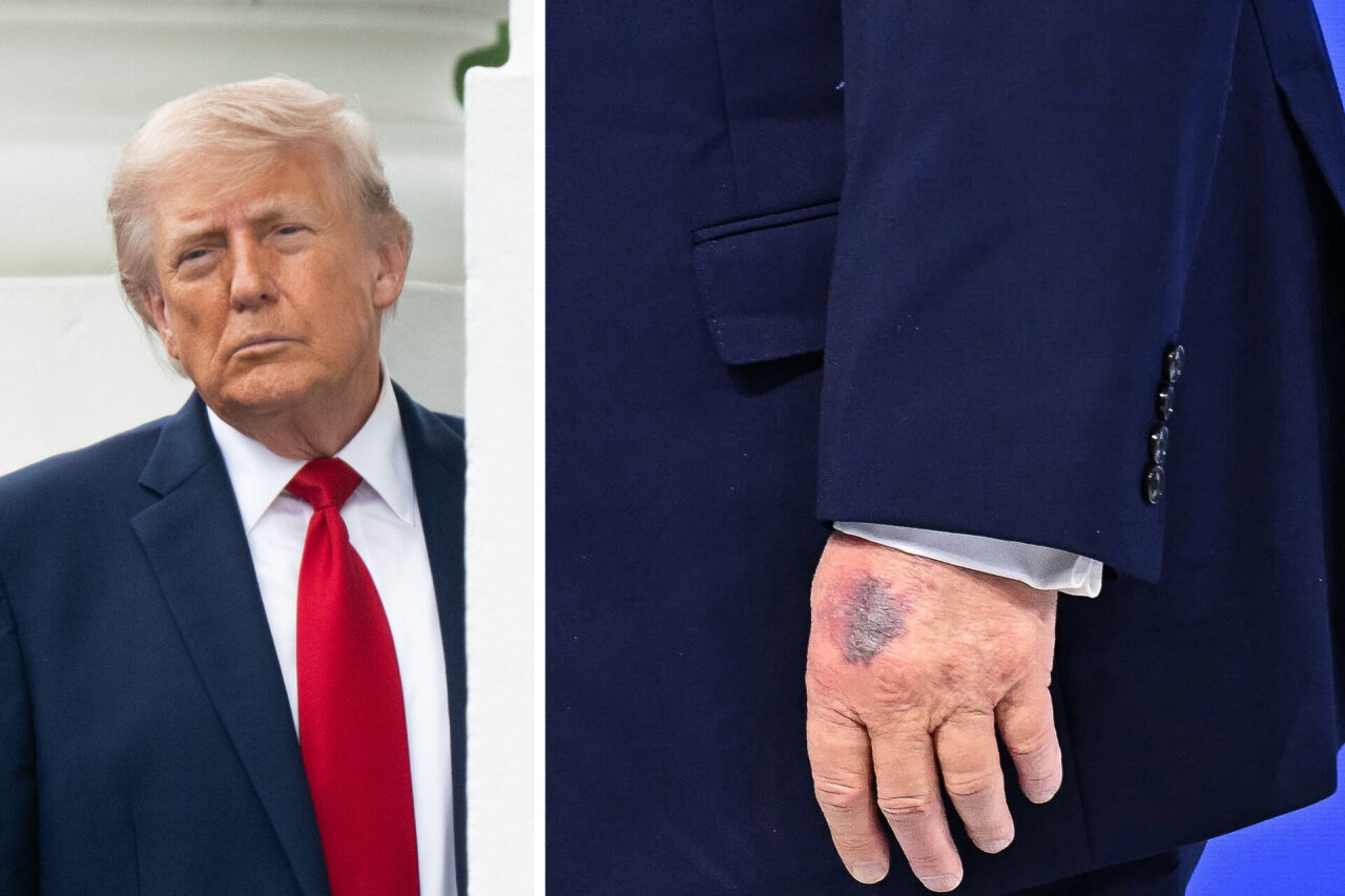 „Nežinau, kaip jis gyvas“: dėl Trumpo sveikatos – daugybė naujų klausimų