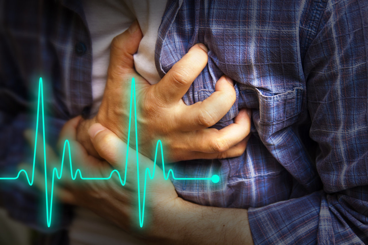 Infarktą signalizuojanti krūtinės angina: jausmas lyg kažkas spaustų