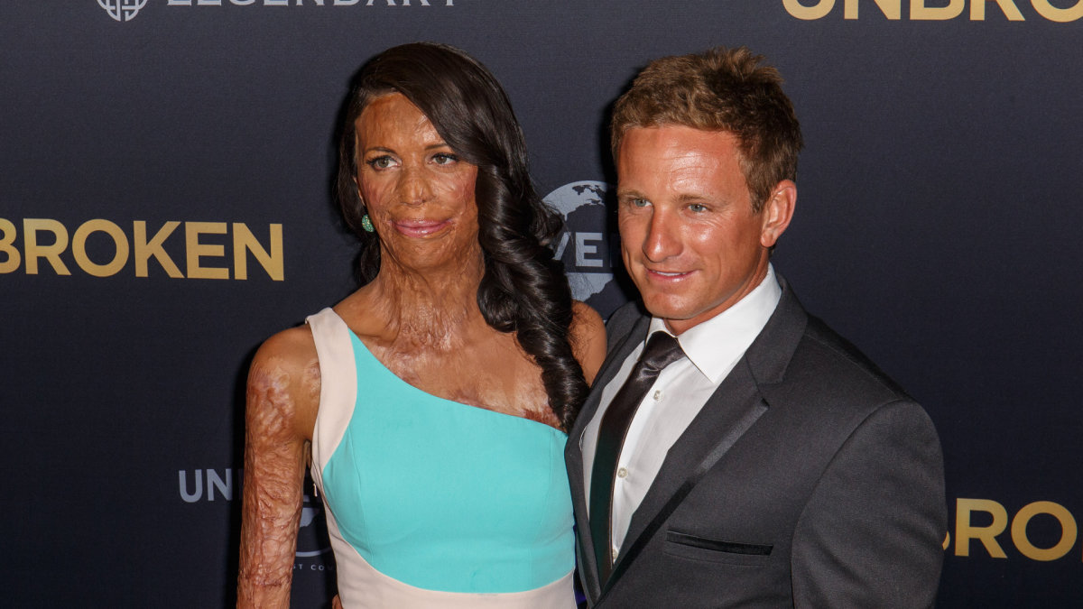 Turia Pitt ir Michaelas Hoskinas