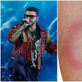 Justinui Timberlake'ui diagnozuota Laimo liga