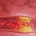 Cholesterolis