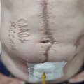 Nuotrauka, kurioje matyti i&scaron; Rusijos nelaisvės grįžęs Ukrainos kari&scaron;kis su ant pilvo i&scaron;raižytu užra&scaron;u &bdquo;&Scaron;lovė Rusijai&ldquo;