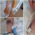 Užfiksuoti sužalojimai