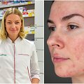 Farmacininkė Fausta Barisevičienė &ndash; apie odos erkutes