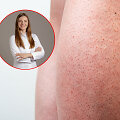 Gydytoja dermatologė Aurėja Kontrimienė pataria, kaip i&scaron;vengti bra&scaron;kinės odos