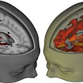 Smegenų palyginimas &ndash; kairėje pusėje &ndash; įprastai dirbančios žmogaus smegenys,de&scaron;inėje &ndash; paveiktos LSD