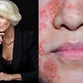 Dermatologė A.Dumbliauskienė / Dermatitas