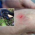 Juodoji angis, gyvatės įkandimo žymės (asociatyvinė nuotr.)