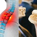 &bdquo;Na&scaron;lės kupra&ldquo; &ndash; vienas i&scaron; trapių kaulų liga vadinamos osteoporozės simptomų