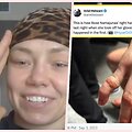 Rugsėjo pradžioje sužalotas Rose Namajunas pir&scaron;tas gyja ilgai.