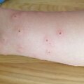 Įspėja poilsiautojus: po maudynių viename Lietuvos ežere gali atsirasti skausmingas bėrimas ir niežulys