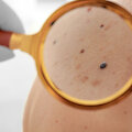 Melanoma