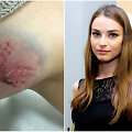 Linai Anu&scaron;auskienei įkando svetimas &scaron;uo