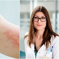 Saulės dilgėlinė / Gydytoja alergologė ir klinikinė imunologė dr. Neringa Stirbienė