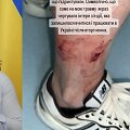 Ukrainos užsienio reikalų ministrą Dmytro Kulebą apkandžiojo &scaron;uo