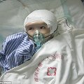 Pirmą kartą pasaulyje trimetei mergaitei i&scaron; Kinijos persodintas 3D spausdintuvu sukurtas vir&scaron;ugalvis