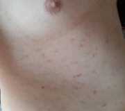 Taip atrodė Deivido kūnas po erkės įkandimo. I&scaron; niekur atsirandančios žaizdos &ndash; vienas Bartoneliozės simptomų.