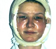 42-ejų Cindy Jackson po operacijos