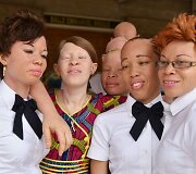 Ugandoje ir Tanzanijoje minėta Tarptautinė albinizmo diena