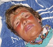 Medūzų sugelta Diana Nyad
