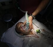 Akhtarui Yarui atliekama nosies operacija