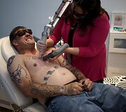 Programos dalyviui lazeriu &scaron;alinama tatuiruotė