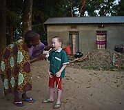 Ugandoje ir Tanzanijoje minėta Tarptautinė albinizmo diena