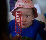Ugandoje ir Tanzanijoje minėta Tarptautinė albinizmo diena