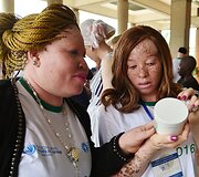 Ugandoje ir Tanzanijoje minėta Tarptautinė albinizmo diena