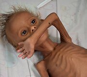 Nuo maisto trūkumo kenčiantis berniukas ligoninėje Jemene