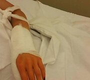 Sandros Navickaitės ranka po operacijos