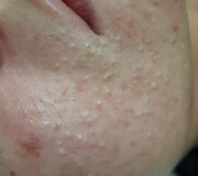 Biorevitalizacija ir rūg&scaron;tinis odos valymas &ndash; procedūros, leidžiančios džiaugtis atjaunėjusiu savo atvaizdu