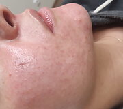 Biorevitalizacija ir rūg&scaron;tinis odos valymas &ndash; procedūros, leidžiančios džiaugtis atjaunėjusiu savo atvaizdu