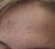 Biorevitalizacija ir rūg&scaron;tinis odos valymas &ndash; procedūros, leidžiančios džiaugtis atjaunėjusiu savo atvaizdu