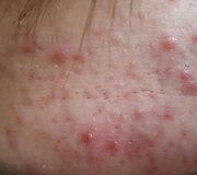 Biorevitalizacija ir rūg&scaron;tinis odos valymas &ndash; procedūros, leidžiančios džiaugtis atjaunėjusiu savo atvaizdu