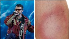 Justinui Timberlake'ui diagnozuota Laimo liga