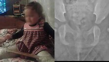 Auksei nustatyta įgimta sunkaus laipsnio displazija: laukia operacija