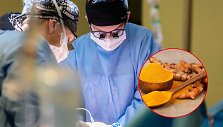 Kepenų transplantacija