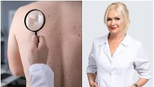 Dermatovenerologė Inga Valavičienė &ndash; apie įvairiaspalvę dedervinę