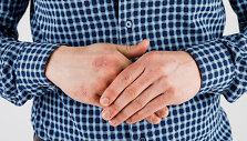 Psoriazė