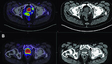 Medikai vykdo pacientų, sergančių prostatos vėžiu, tyrimus taikydami pažangią vaizdinimo technologiją, vadinamą PSMA PET/CT