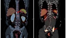 Medikai vykdo pacientų, sergančių prostatos vėžiu, tyrimus taikydami pažangią vaizdinimo technologiją, vadinamą PSMA PET/CT