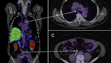 Medikai vykdo pacientų, sergančių prostatos vėžiu, tyrimus taikydami pažangią vaizdinimo technologiją, vadinamą PSMA PET/CT