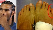 Davidas Haye internete i&scaron;platino savo pėdų nuotrauką, kuriame matomas i&scaron;tinęs pir&scaron;tas.