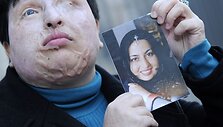 Ameneh Bahrami laiko nuotrauką, kurioje ji užfiksuota prie&scaron; užpuolimą, kai jos veidas ir akys buvo apipiltos rūg&scaron;timi.
