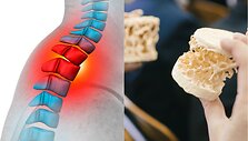 &bdquo;Na&scaron;lės kupra&ldquo; &ndash; vienas i&scaron; trapių kaulų liga vadinamos osteoporozės simptomų