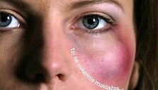 Kauno moterų draugijos kovos su smurtu prie&scaron; moteris simbolis - plakatas su sumu&scaron;ta moterimi