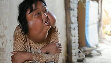 70 auglių ant veido turėjusi kinė Li Hongfang